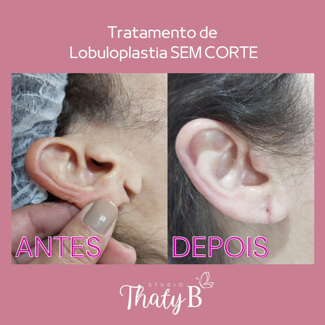Tratamento de Lobuloplastia SEM CORTE (1)