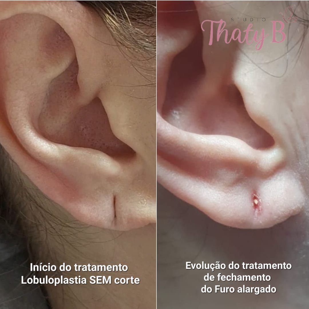 Lobuloplastia